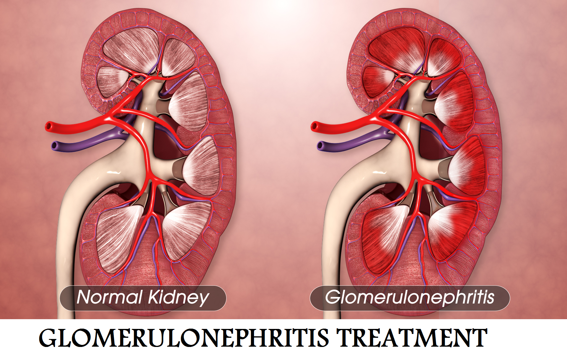 Best Glomerulonephritis Treatment